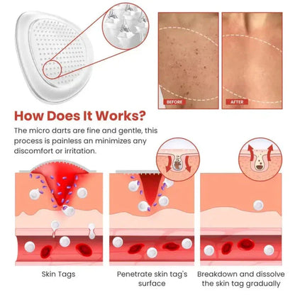Derma Smooth Skin Tag Remover Patch