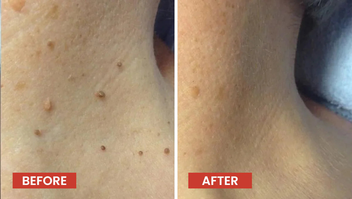 Derma Smooth Skin Tag Remover Patch